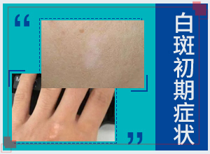 白點(diǎn)風(fēng)能治療嗎-白點(diǎn)癲風(fēng)早期可以治療嗎-正確起效治療