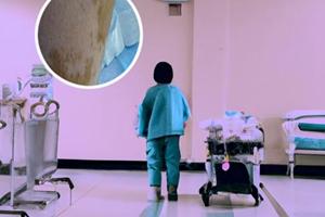 小孩臉上出現(xiàn)白斑怎么治療