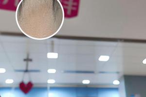 白癜風嘴唇上早期圖