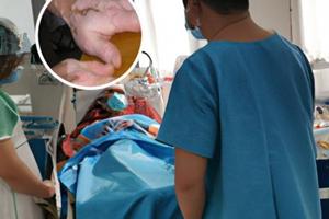 身上長(zhǎng)了個(gè)暈痣代表什么意思