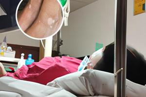 色素脫失可以照308嗎