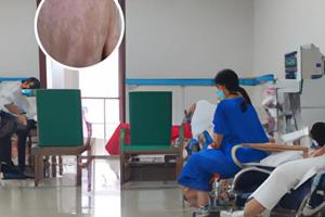 白點癲風不能吃的食物有哪些一覽表最新版